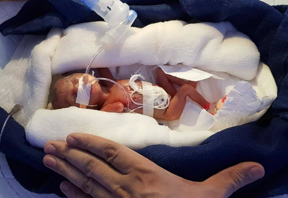La bebé prematura de 400 gramos, el "milagro"que ha dado esperanza a miles de padres